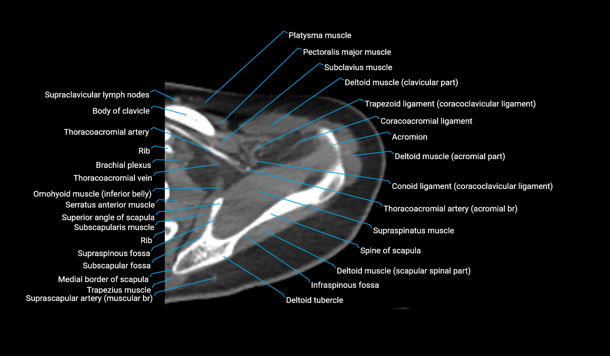 CT upper arm axial  cross sectional anatomy labelled radiology image -00070.webp